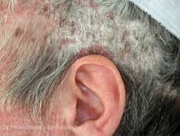 Please see full important safety information. Scalp Psoriasis Dermnet Nz