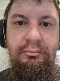 Does this look like uveitis?