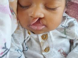 Fundraiser for Gerry Feldman by Ferra Welcome : Cleft lip and palate repair.