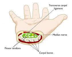 Bensinger on how do i know if i have carpal tunnel: Carpal Tunnel Syndrome Symptoms And Treatment Orthoinfo Aaos