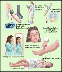 Darah tinggi semasa hamil tidak boleh dipandang ringan. Pra Eklampsia Amaran Bahaya Sebelum Sawan Ketika Hamil Iluminasi