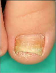 Image result for onychomycosis