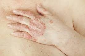 乾癬に効く自然療法 みんな健康 psoriatic arthritis treat psoriasis psoriatic