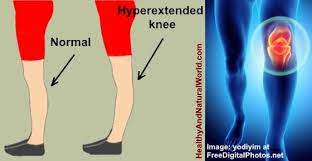 An ice pack may help relieve swelling and discomfort associated with a hyperextended knee. Pin On Struggle Bus