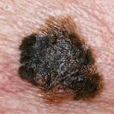 This is the most aggressive type of melanoma.it accounts for 10 to 15 percent of all cases. Melanoma Skin Cancer How A Skin Check Can Keep You Alive