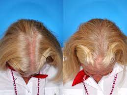 Most recently, researchers have identified a new connection between hair and heart health. Eek Hair Loss In Women Top 7 Risk Factors Revealed Cbs News