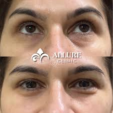 💉 Третиране на околоочната зона с филър Работихме в долината на сълзите,  за да попълним хлътванията и да върнем свежестта на погледа. ✔️Използван е  фин филър, който деликатно изглажда зоната и прикрива