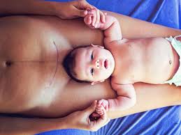 Wann muss man notfallmässig einen kaiserschnitt machen? Wie Sieht Eine Kaiserschnitt Narbe Aus So Individuell Wie Dein Baby Diese Bilder Beweisen Warum Kaiserschnitt Mamas Stolz Auf Sich Sein Konnen Bunte De