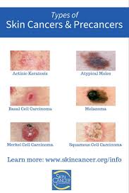 Squamous cell carcinomas can grow inward and spread to the interior of the body. No Sun Screen Stay Out Of The Sun