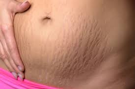 How To Prevent Stretch Marks During Pregnancy