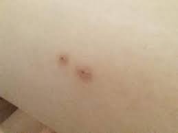 Image result for große winkelspinne biss haut reaktion