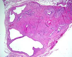 Check spelling or type a new query. Pathology Outlines Adenomyomatous Hyperplasia