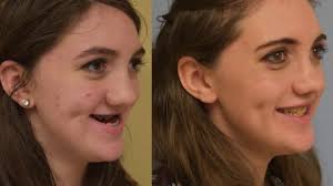 However, treatment decisions are dependent upon each individual and the patient's care team. Fixing A Cleft Palate With Craniofacial Surgery The Science Of Healing Clip Youtube
