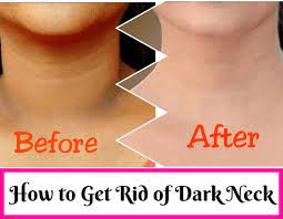 How To Get Rid Of Dark Neck 13 Natural Home Remedies Best Beauty Lifestyle Blog Dark Skin Around Neck Skin Lightening Diy Dark Neck Remedies
