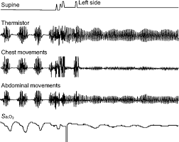 Image result for Cheyne-Stokes Respiration