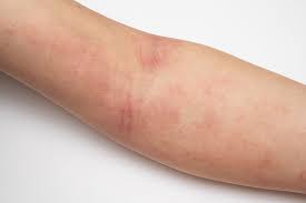 Image result for contact dermatitis