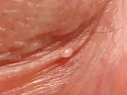 Hi Is This A Pimple Or Tyson Gland? | Penis Disorders | Forums | Patient