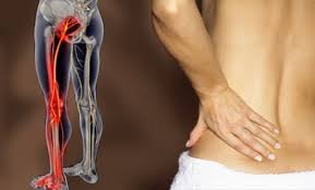 Sciatica Durerea Cruntă Pe Un Picior Doctor Expres