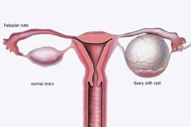 Medical diagram comparing a normal ovary with an ovary enlarged by a cyst