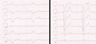 An ekg is a paper or digital recording of the electrical signals in the heart. Ekg Bei Dilatativer Kardiomyopathie Fokus Ekg