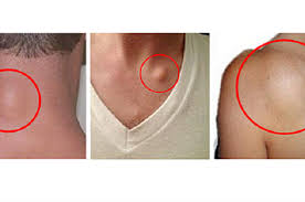 Modifikasi gerakan ini dengan menarik pelan kepala. Tanpa Operasi Begini Cara Menghilangkan Lipoma Dalam 8 Hari Semua Halaman Nakita