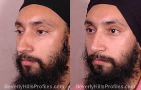 Rhinoplasty Before After Photos Beverly Hills La Rhinoplasty rhinoplasty before after photos