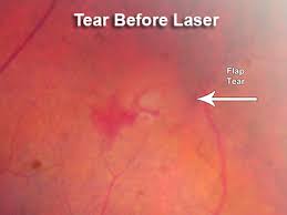 A detached retina is when your retina lifts away from the back of the eye. Retinal Tear