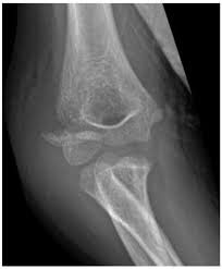 Image result for Lateral Condyle Fracture