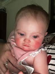 Has anyone ever tested positive to Dengue fever with no fever and no rash  and no headache, no behind the eye pain? Highly possible it is 'Fiji Belly'  I am experiencing. But