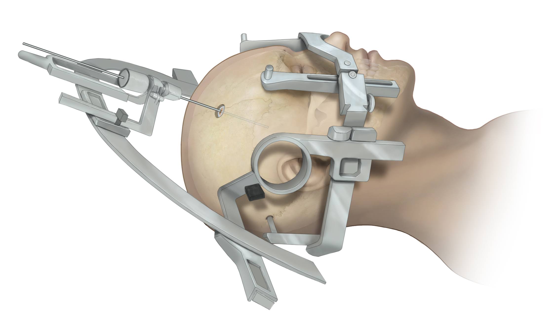 Stereotactic Neurosurgery product image