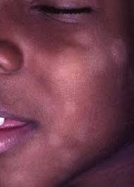 We did not find results for: Pityriasis Alba Bilder