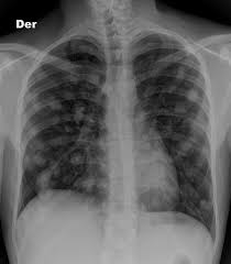 The m in the tnm system describes whether the cancer has spread to other parts of the body, called distant metastasis. Lung Metastases From Testicular Cancer Radiology Case Radiopaedia Org