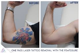 The type of laser used to remove a tattoo depends on the tattoo's pigment colors, he adds. The Fastest Laser Tattoo Removal Laser Ever The Femtosure Laser By Astanza