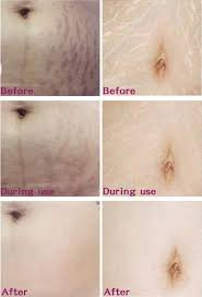 Bio Oil Pregnancy Stretch Marks Before And After Birth Stretch Mark Cream Stretch Marks Stretch Mark Cream Stretch Mark Removal Cream