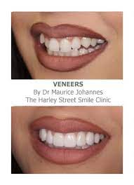 If you discuss your preferences with a dentist or orthodontist, they can tell you if a certain form of treatment is suitable in your case. Veneers For Crooked Teeth Harley Street Smile Clinic