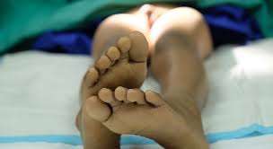 Image result for Phimosis