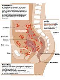 Endometriosis is characterized by the presence of endometrium and endometrial stroma outside the uterine cavity, in other parts of the female body. Wucherndes Gewebe Endometriose Tuckische Krankheit Der Frauen
