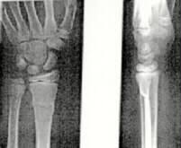 Deutsches Medizin Netzstartseite Handgelenksbruche Distale Radiusfrakturen