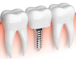 It's such an honor for us to help you claim a smile you love! Tempe Dentist 85283 Noble Dental Care