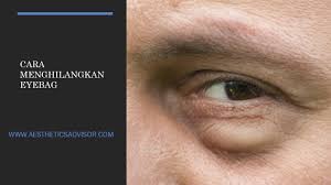 Cara menghilangkan kantung mata secara alami dan ampuh bisa anda temukan di sini. Macam Mana Nak Hilangkan Eyebag Di Malaysia 2020