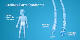 Most people recover fully, but some have permanent nerve damage. Guillain Barre Syndrome Boston Children S Hospital