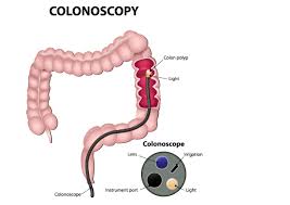Image result for Colonic Polyp