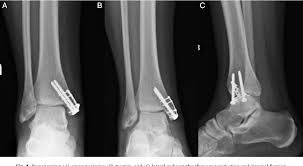 Accurate diagnosis followed by a comprehensive physiotherapy rehabilitation. Incarceration Of The Posterior Tibial Tendon In An Isolated Comminuted Medial Malleolus Fracture Semantic Scholar