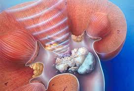 This pain is often severe enough to send blood tests can help look for high levels of minerals involved in forming kidney stones. Kidney Stone Pictures Symptoms Causes Treatments And Passing Stones