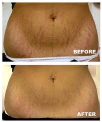 Bio Oil Gel Before And After How To Get Rid Of Stretch Marks Vergetures Sante Et Beaute Produits De Beaute