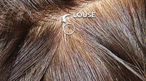 Bird mites on humans look like hair dead nit in dark hair. Checking For Lice Screenings Lice Clinics Of America Medway Ma