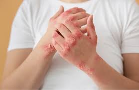 Image result for Urticaria pigmentosa children