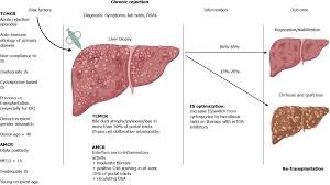 Image result for Transplant Rejection