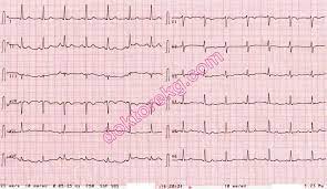 Sick Sinus Syndrome And The Electrocardiography Ecg Bradycardia Tachycardia Syndrome Hasta Sinus Sendromu Ve Elektrokardiyografi Ekg Ankara Kardiyoloji Mete Alpaslan Kalp Hastaliklari Doktorekg Com