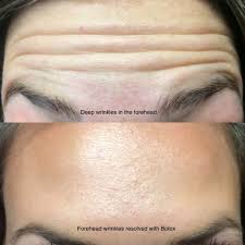 After having botox in your forehead, avoid wearing anything which may fit tightly across your forehead, such as a hat or headband. Botox And Wrinkle Before After Pictures Vivaa